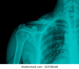 379 Broken collarbone Images, Stock Photos & Vectors | Shutterstock