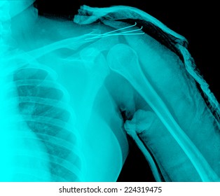 X- ray of collarbone