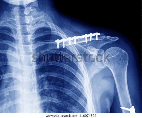 X Ray Collarbone Stock Photo Edit Now 116074324