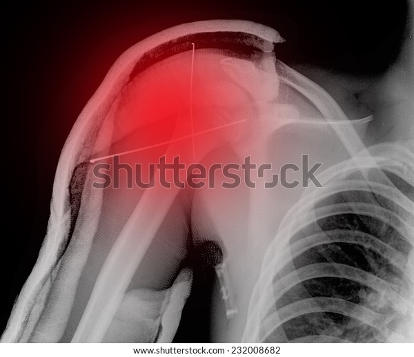 X Ray Collarbone Stock Photo 232008682 Shutterstock