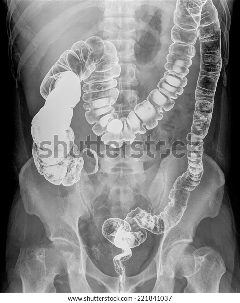 X Ray Colon Bariumap View Pre Stock Photo (Edit Now) 221841037