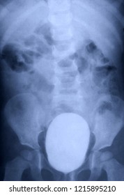 X Ray Contrast Study Of Full Bladder Of Child - Medical Cystography Diagnostic Test - Xray, MRI, CT Scan Film
