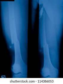 X Ray Film Of Distal Femur Fracture.