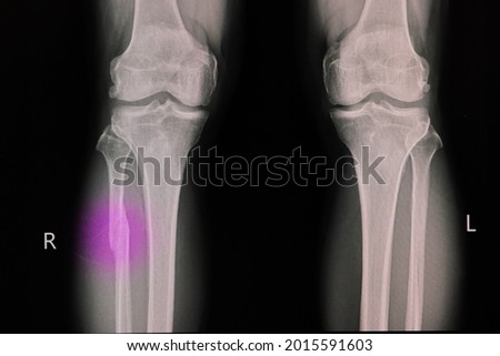 X -ray film of a knee of a patient with fractured proximal fibula. Leg bone fracture.