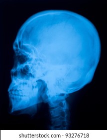  X ray film  of skull lateral