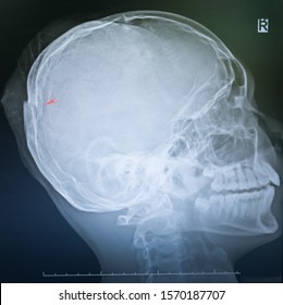 X Ray Film Of A Skull Of A Patient Suffering From Traumatic Injury Showing Broken Fractured Skull Bone