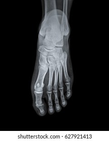 X Ray  Of Foot Of Human Anterior View.