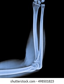 X Ray Of Forearm With Elbow Joint.