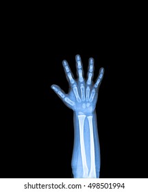 X Ray Of Hand Of Child.