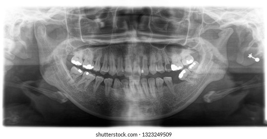 X Ray Human Mouth Teeth Bones Stock Photo 1323249509 | Shutterstock