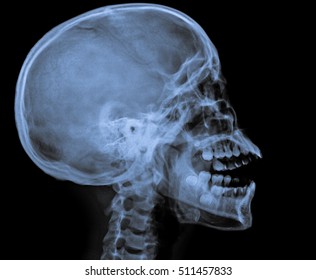 X RAY OF HUMAN SKULL