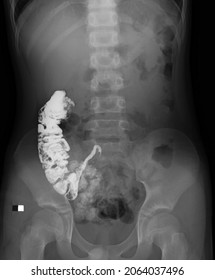 X Ray Image Of Appendix .appendicography