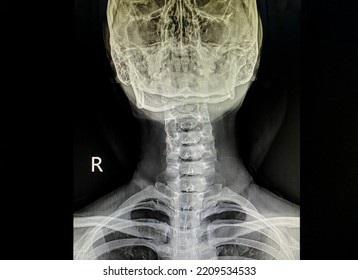 X Ray Image Of Cervical Spine Level