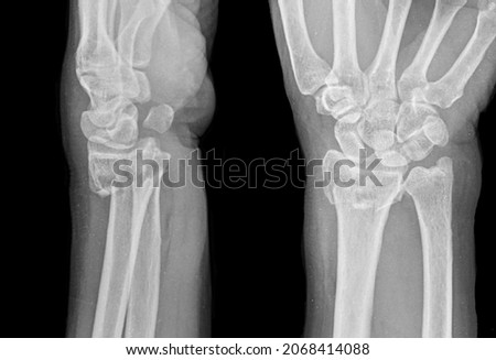 x ray image of distal radius fracture colles fracture
