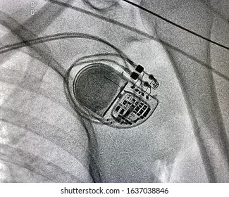 X ray image during permanent pacemaker implantation procedure