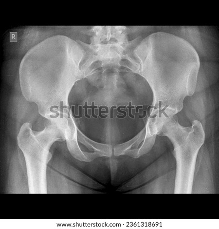X ray image of female pelvis bone and hip joints 