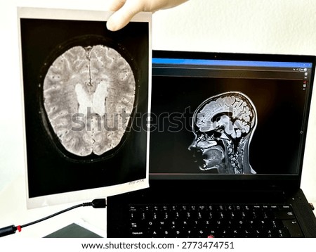 x ray image of human brain. A picture of the brain in the hands of a doctor on the background of a laptop with an MRI of a person's head.