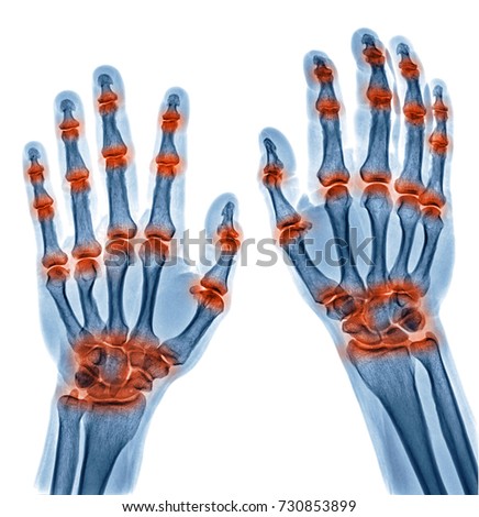 x ray image of multible joint inflammation in both hands caused by Gout arthritis, Rheumatoid arthritis isolated on white background