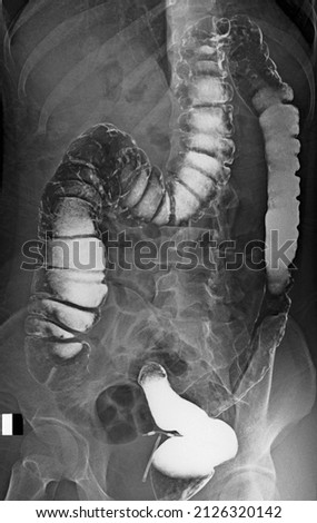 x ray image of normal  barium enema