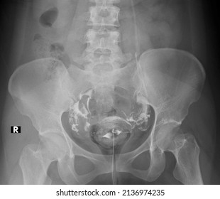 X Ray Image Normal Hysterosalpingography Hsg Stock Photo (Edit Now ...