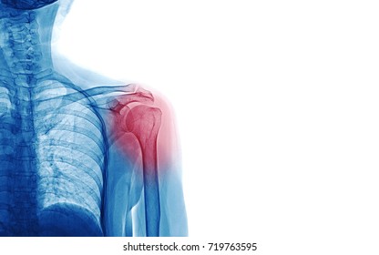 X Ray Image Of Patient Who Have Shoulder Pain Isolated On White Background, Space For Your Message And Idea Medical Concept