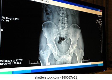 X Ray Image Of Pelvis A Human Body On The Computer Monitor