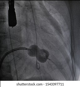 X Ray Image Perform Balloon Catheter Inflation In Percutaneous Transvenous Mitral Commissurotomy (ptmc) Procedure