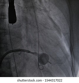 X Ray Image Perform Balloon Catheter Inflation In Percutaneous Transvenous Mitral Commissurotomy (PTMC) Procedure