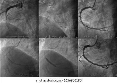 X Ray Image Was Performed Percutaneous Coronary Intervention (PCI) Of Right Coronary Artery (RCA)