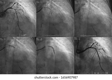 X Ray Image Was Performed Percutaneous Coronary Intervention (PCI) Of Left Anterior Descending Artery (LAD)