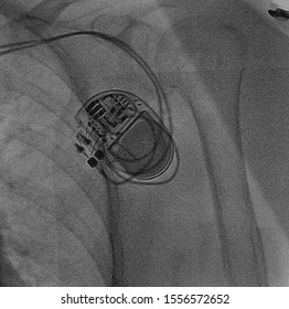 X ray image of permanent pacemaker implantation in patient chest body