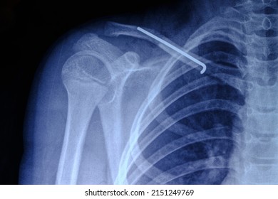 X Ray Image Person With Broken Collarbone And Spoke Installed In It After Surgery