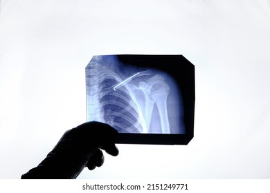 X Ray Image Person With Broken Collarbone And Spoke Installed In It After Surgery