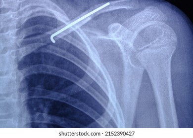 X Ray Image Person With Broken Collarbone And Spoke Installed In It After Surgery