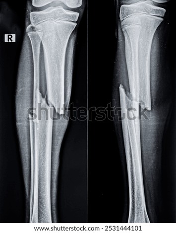 X ray image of shaft of tibia and fibula fracture 