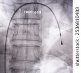 X ray image show that single chambers Permanent Pacemaker leads was inserted to right heart chambers.