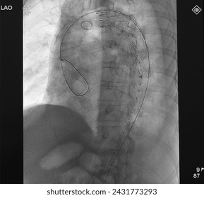 X ray image showed aortic stent graft at thoracic aorta in thoracic endovascular aortic repair (TEVAR) procedure.