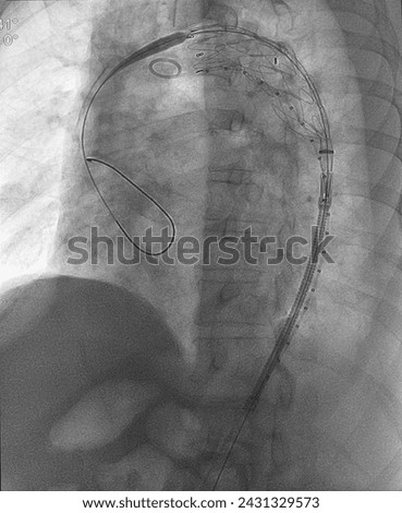 X ray image showed aortic stent graft deployment at thoracic aorta in thoracic endovascular aortic repair (TEVAR) procedure.