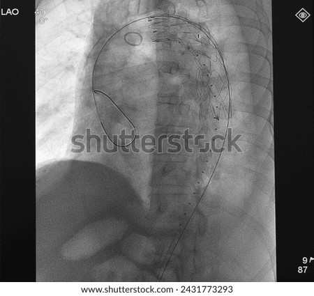 X ray image showed aortic stent graft at thoracic aorta in thoracic endovascular aortic repair (TEVAR) procedure.