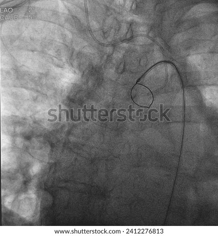 X ray image showed loop of snare catheter to pull tip of diagnosis catheter in ascending aorta.