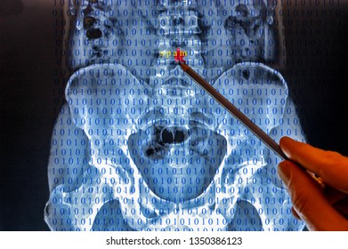 X ray image of a spine with binary code. Pencil points out inflammatory spot of spine as virus infected causing serious health problems.