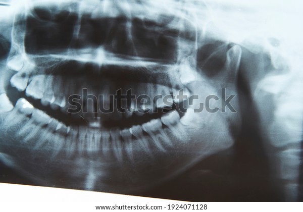 x ray image of\
teeth