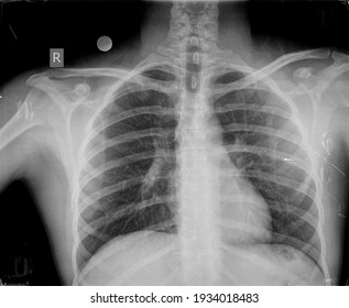 X Ray Images Of Lung