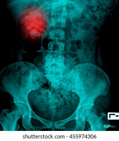 X Ray Kidney Stones Stock Photo 455974306 | Shutterstock