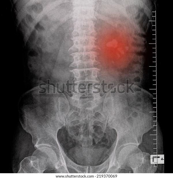 X Ray Kidney Stones Stock Photo (Edit Now) 219370069