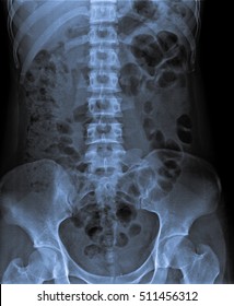 x ray kidney ureter and bladder with IVP