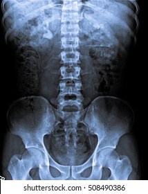 x ray kidney, urinary and bladder.