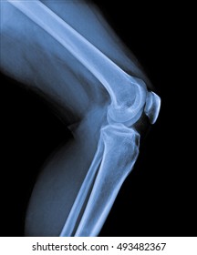 X Ray Of Knee Joint Side View.