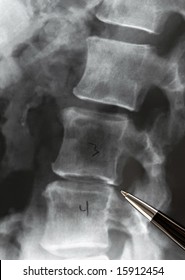 X ray. Lateral Lumbar Spine