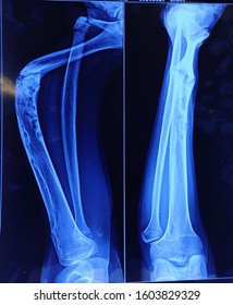 X Ray Of Lower Limb With Disease Conditions.